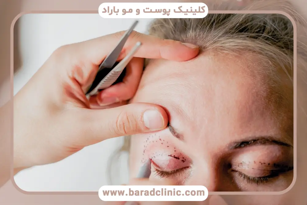 عوارض عدم درمان افتادگی پلک چیست؟