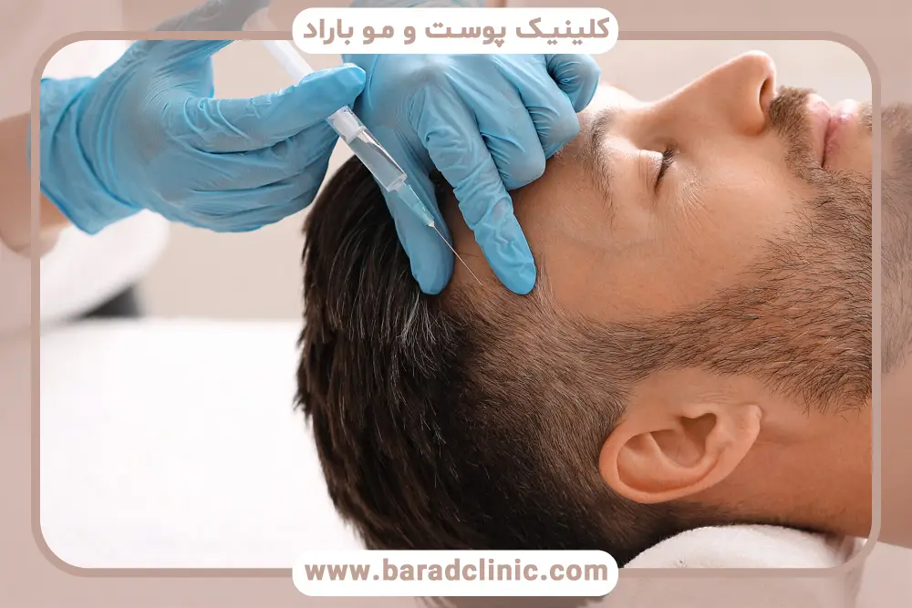 بعد از کاشت مو پی آر پی بهتر است یا مزوتراپی؟ مقایسه جامع