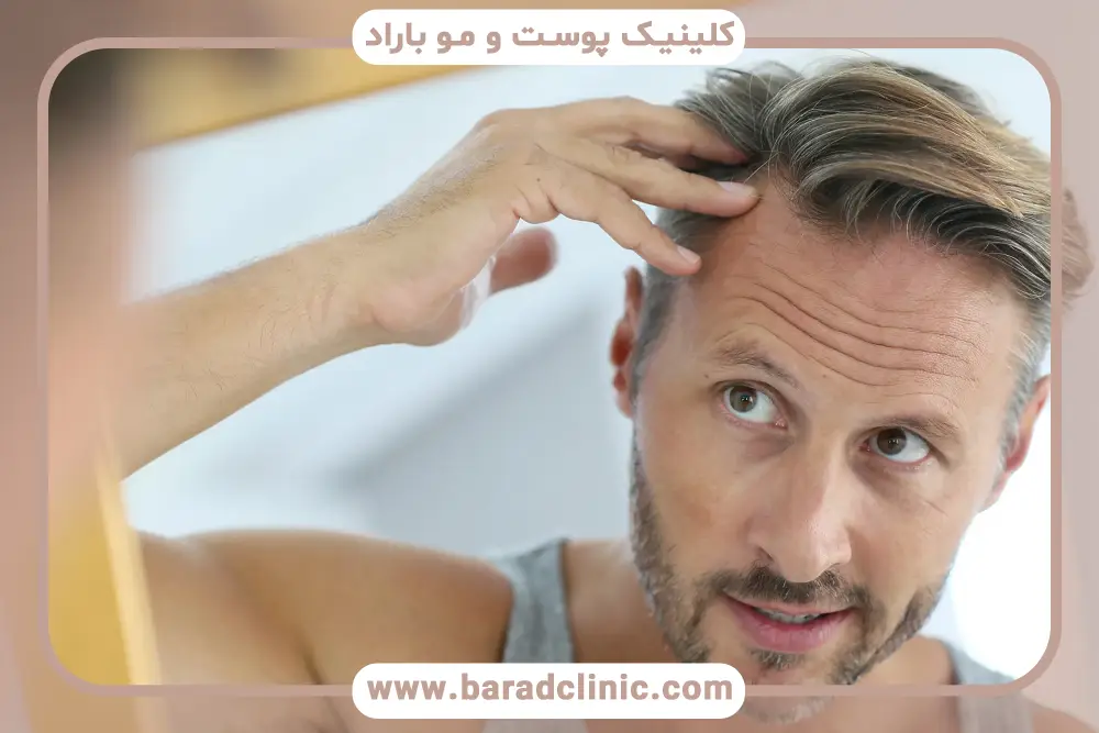 روش‌های جلوگیری از ریزش مو در مردان 