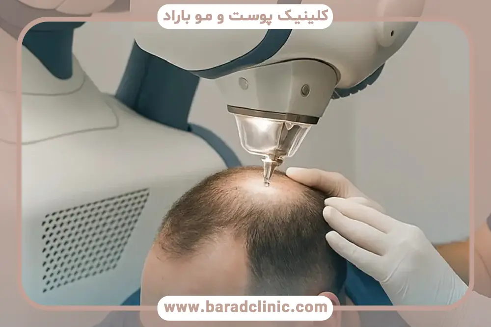 درصد بقای گرافتها در کاشت مو با دستگاه بهتر است یا با دست؟