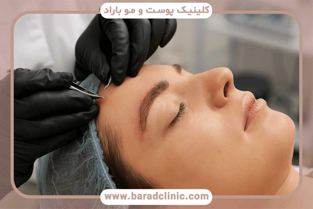 نتایج کاشت ابرو