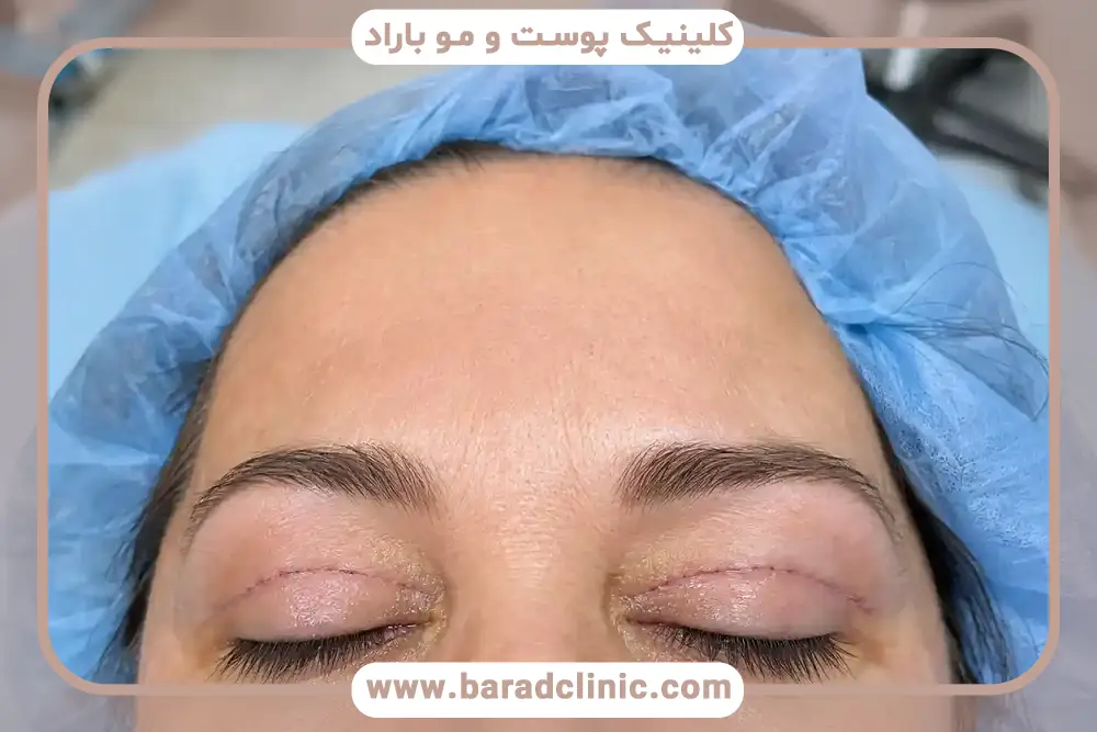 مراقبتهای دوره نقاهت عمل بلفاروپلاستی