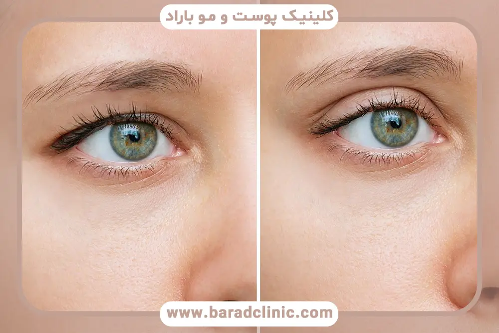 بررسی علائم افتادگی پلک