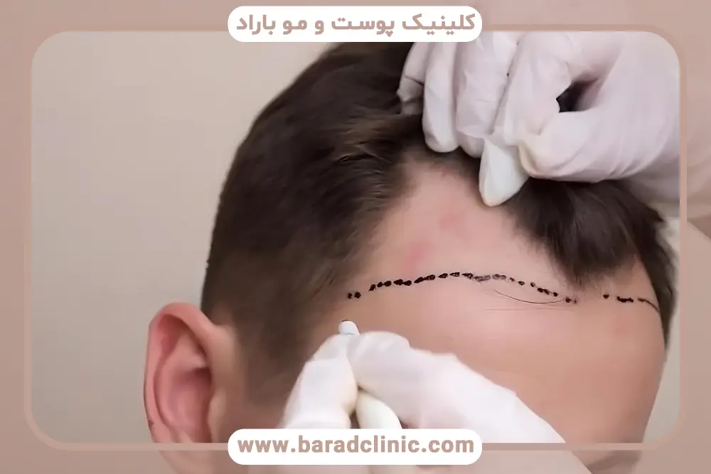 شرایط پرداخت اقساطی هزینه کاشت مو با تراکم بالا
