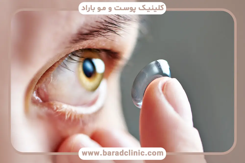 روش استفاده از لنز بعد از جراحی بلفاروپلاستی