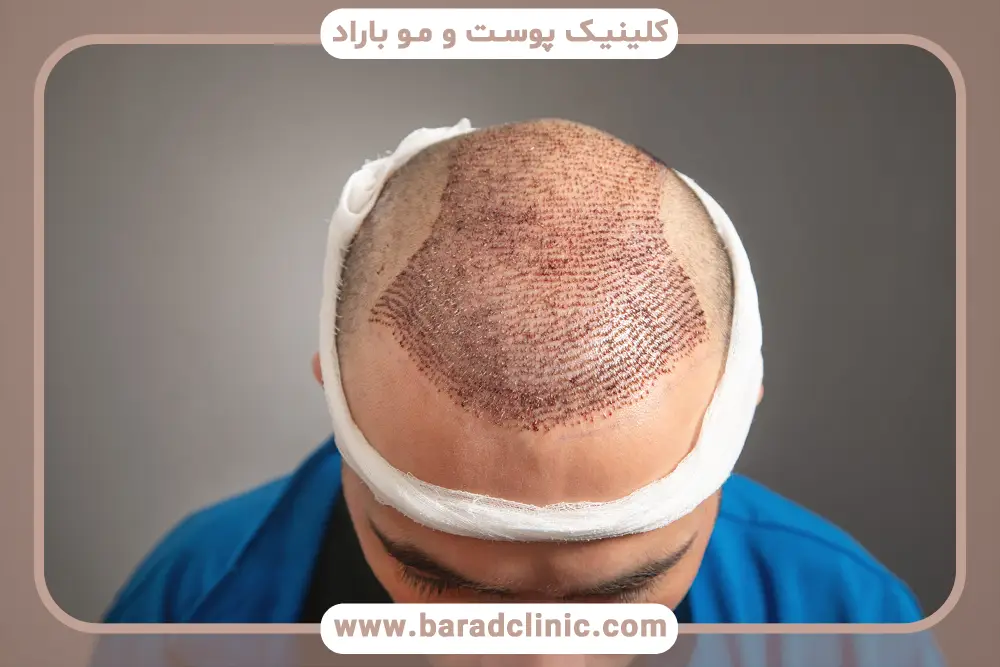 بررسی آخرین وضعیت کاشت مو به روش تکثیر پیاز مو