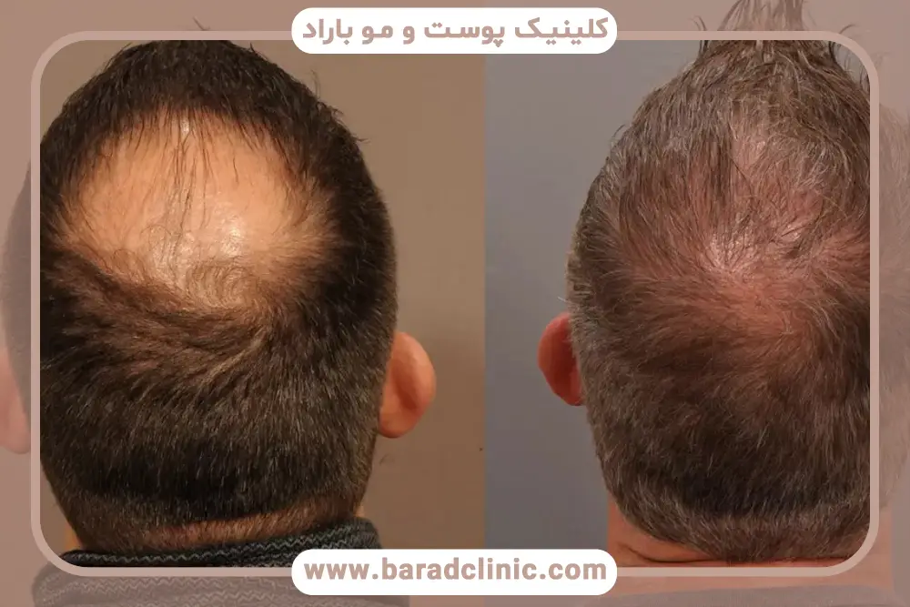 کاندیدای کاشت مو بدون سوزن بی حسی 