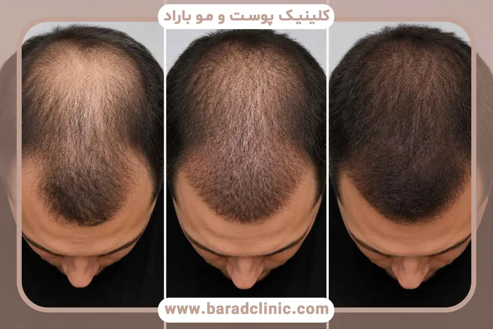 تفاوت کاشت مو به روش sut و fue در عوارض جانبی