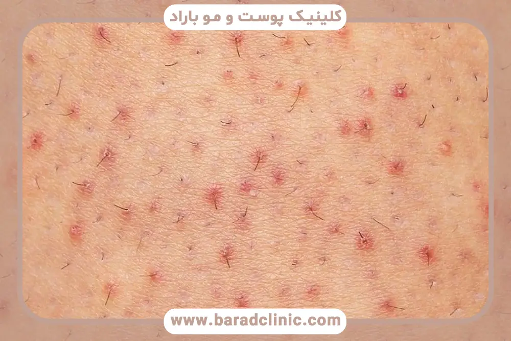راهکارهای درمانی فولیکولیت ریش