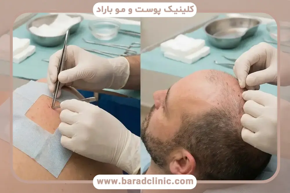 محدودیت‌های کاشت مو به روش hrt 