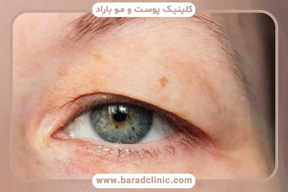 روشهای تشخیص افتادگی پلک چیست؟