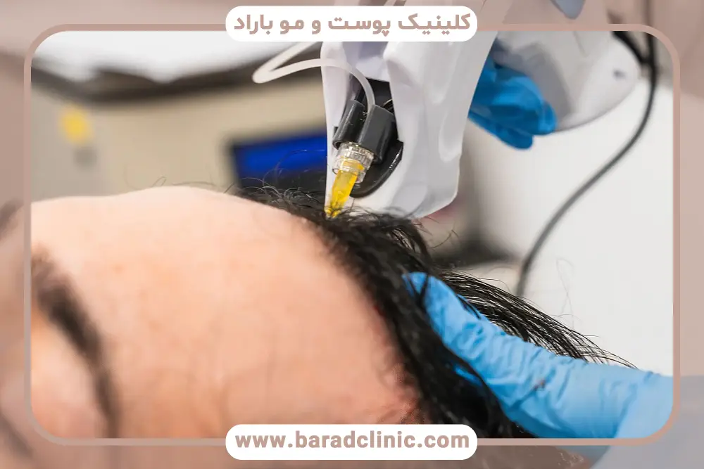 بعد از کاشت مو پی آر پی بهتر است یا مزوتراپی؟ تفاوت هزینه‌ها