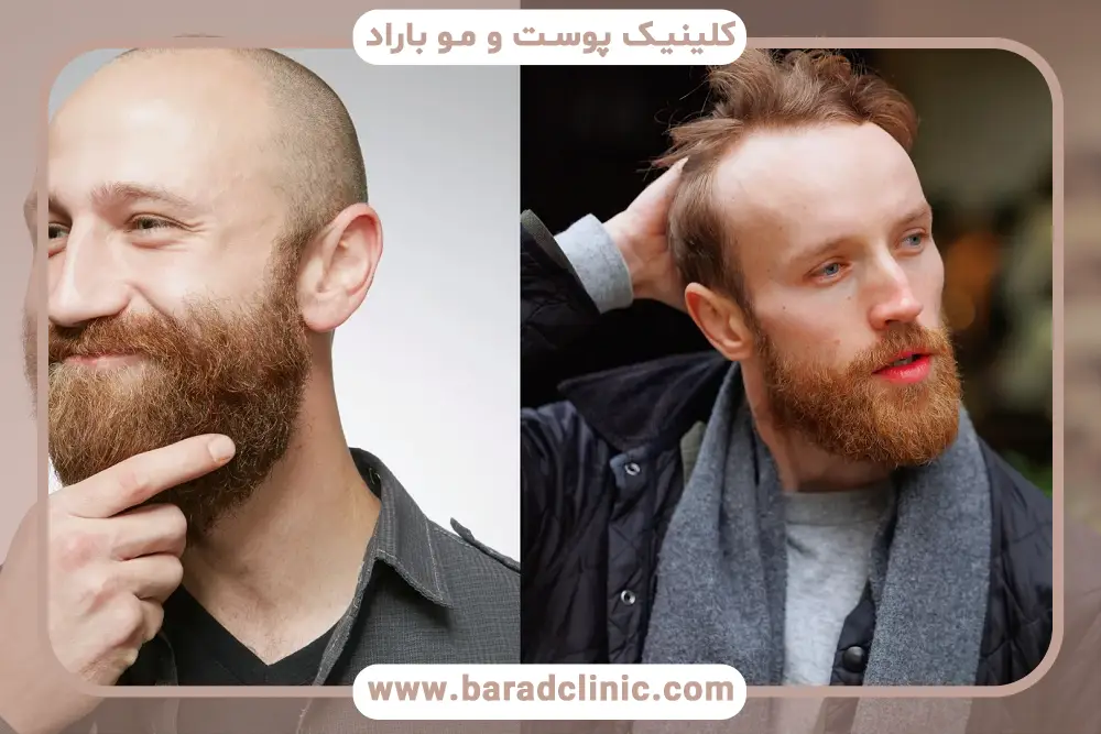 روش‌های کلینیکی جلوگیری از ریزش مو در مردان 