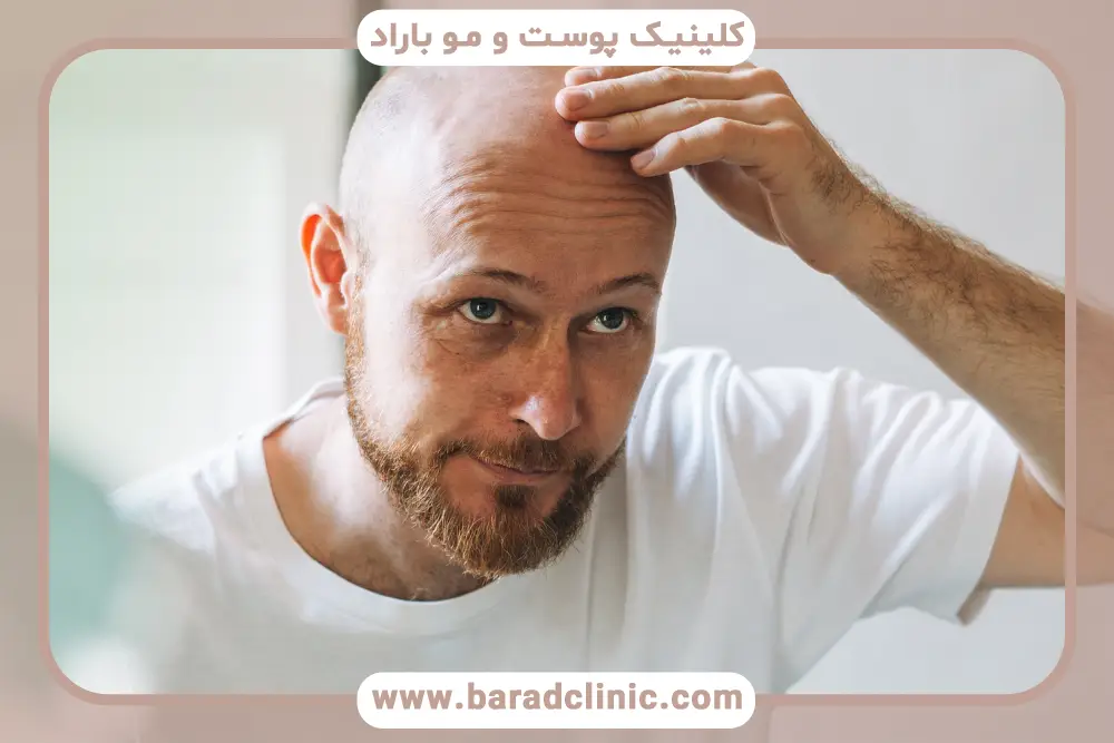 بیماری‌هایی که علت طاسی مردان  هستند