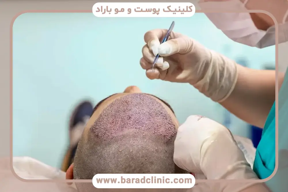کاهش خطای کاشت مو با دستگاه بهتر است یا با دست؟
