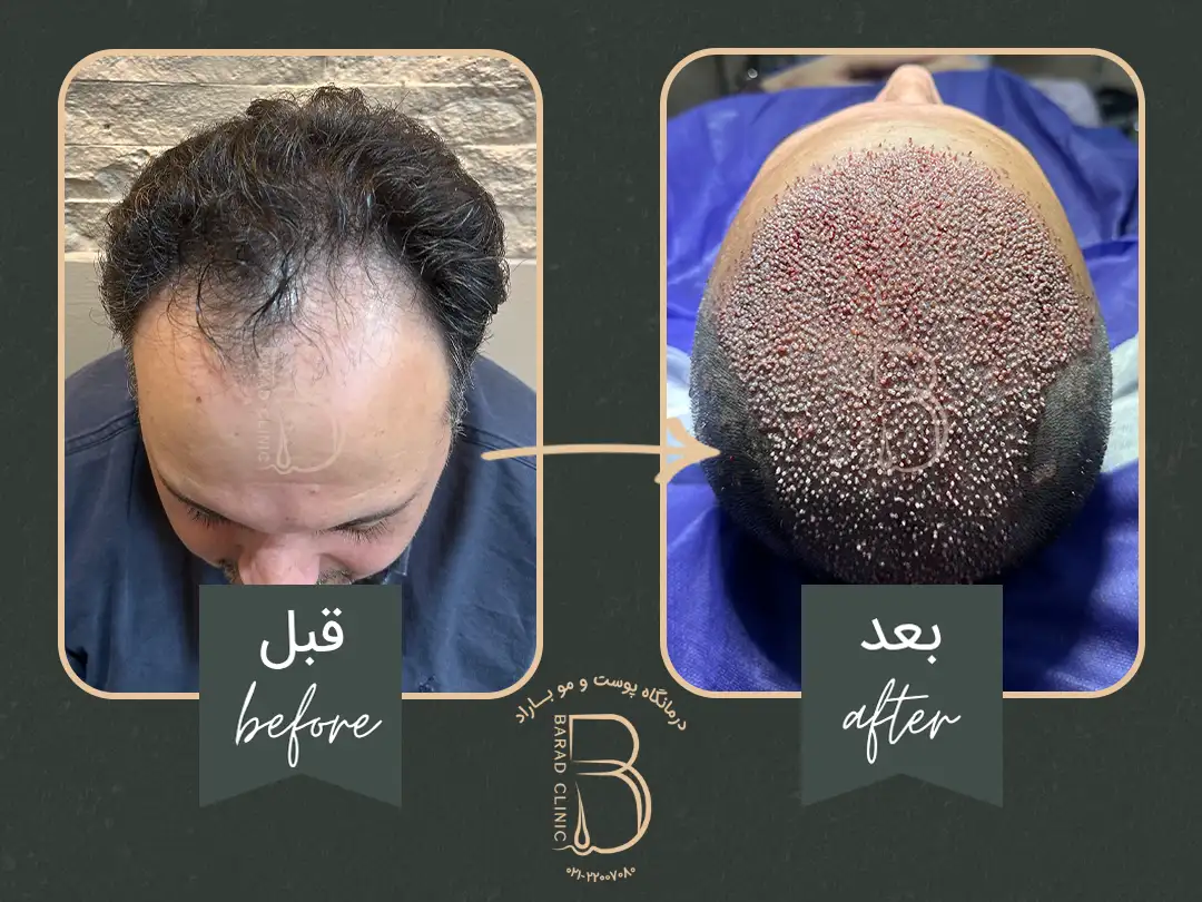 جراحی کاشت بلافاصله بعد از عمل