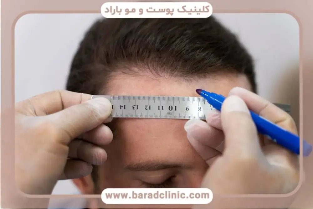 کاشت مو در جهان و ایران