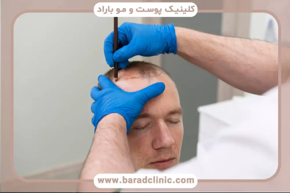 انواع روش های کاشت مو