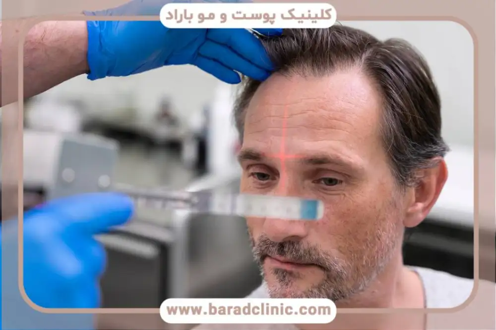 مراقبت های بعد از جراحی کاشت مو