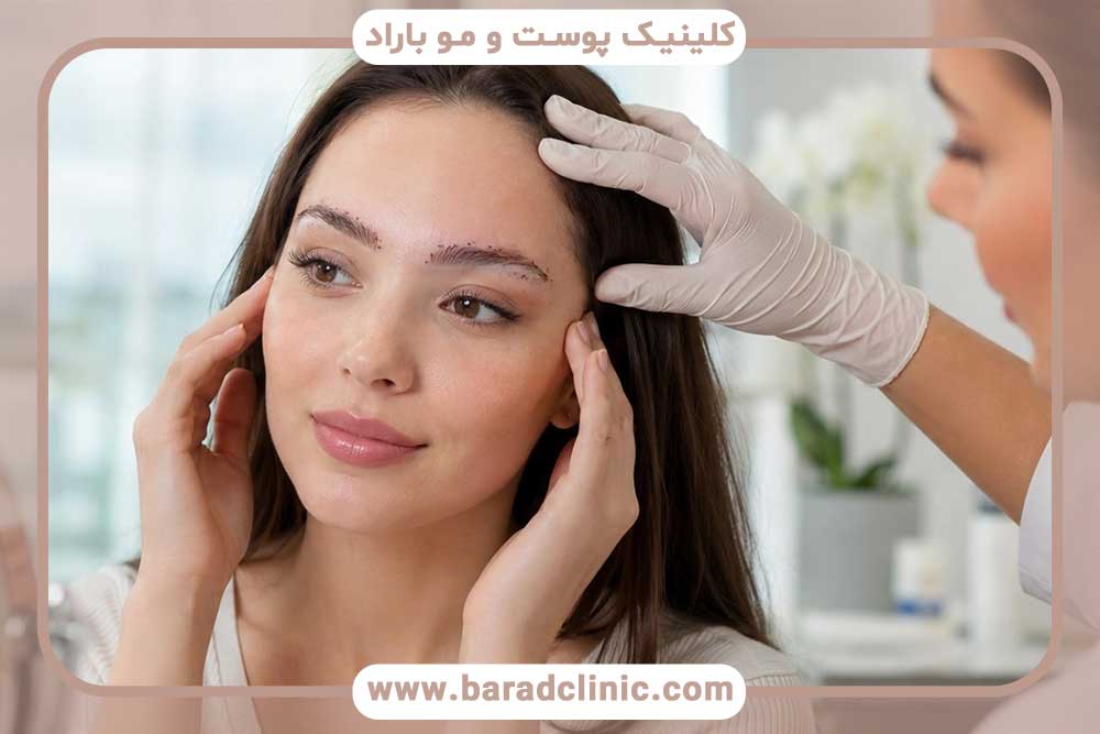درمان پوسته پوسته شدن ابرو بعد از کاشت؛