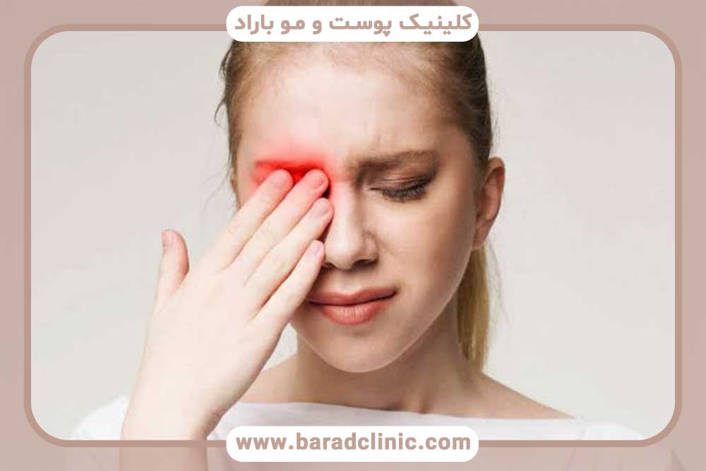 علت سوزش ابرو بعد از کاشت