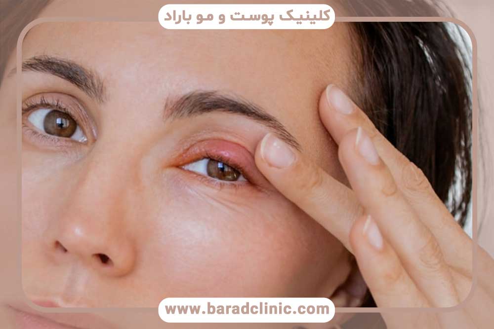 ورم بعد از کاشت ابرو