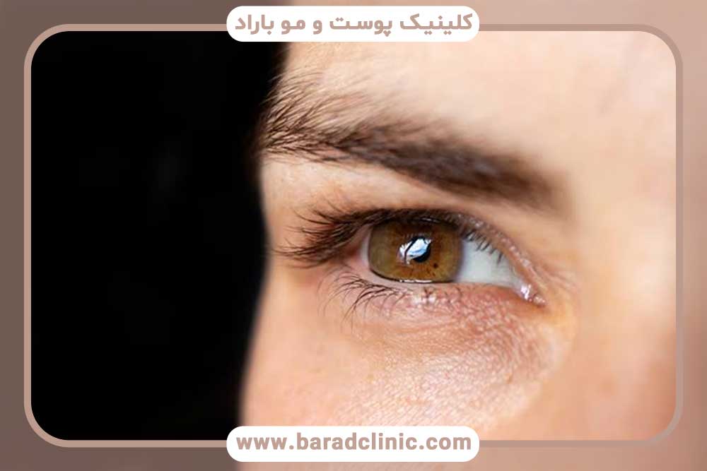 پرسش و پاسخ کاشت ابرو