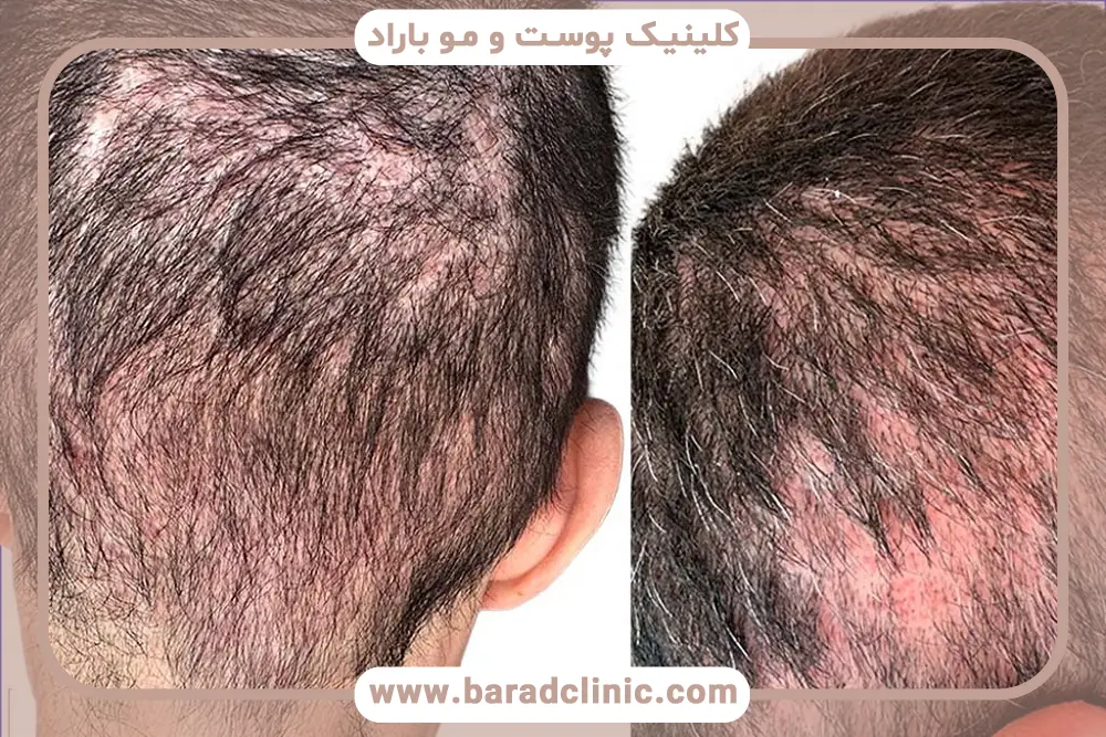 بهترین روش کاشت مو برای افراد با بانک موی ضعیف