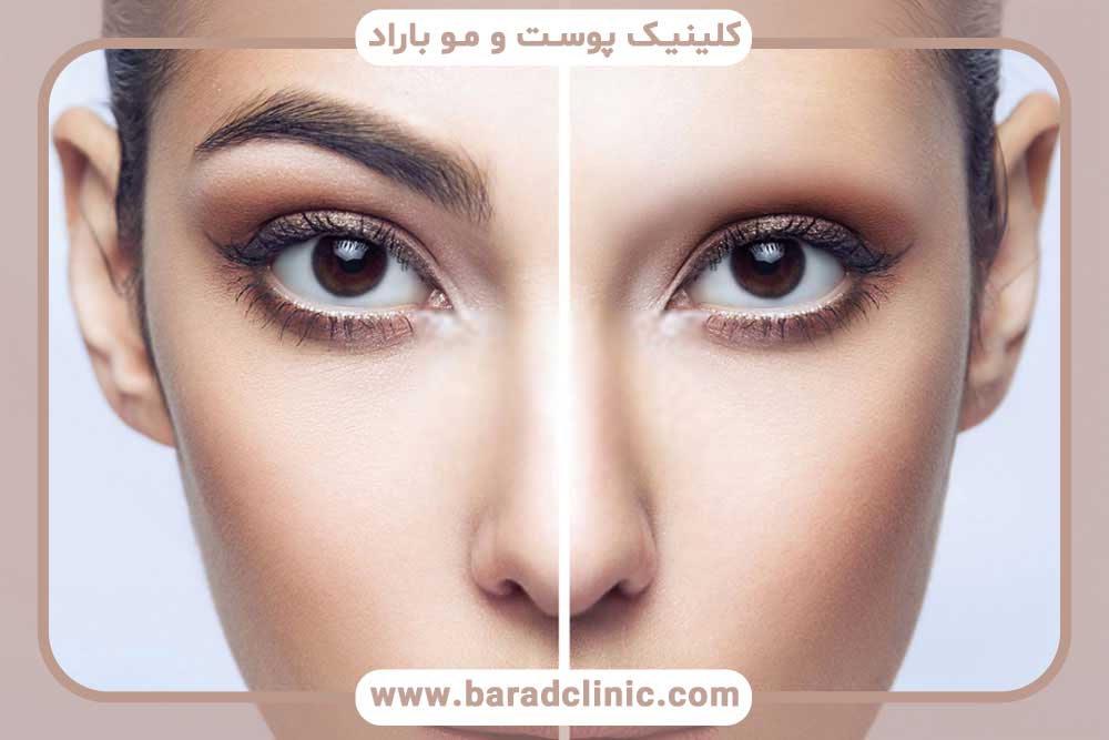 بهترین دکتر کاشت ابرو