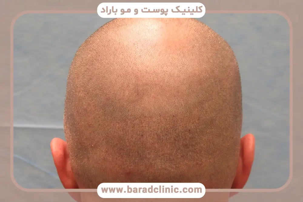 تقویت بانک مو قبل از کاشت