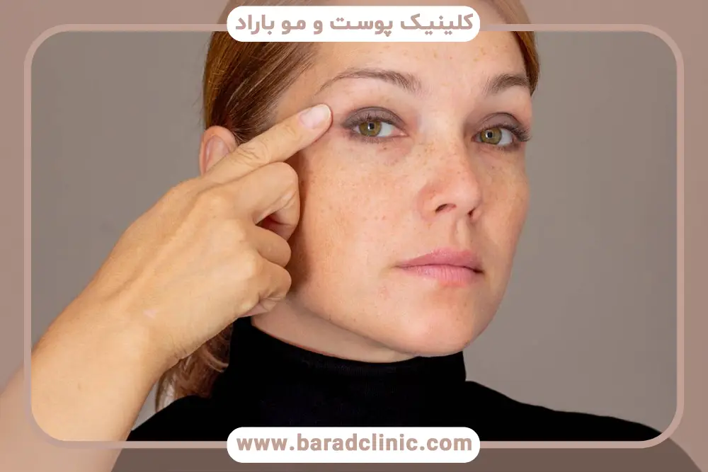 عدم تقارن چشم بعد از بلفاروپلاستی