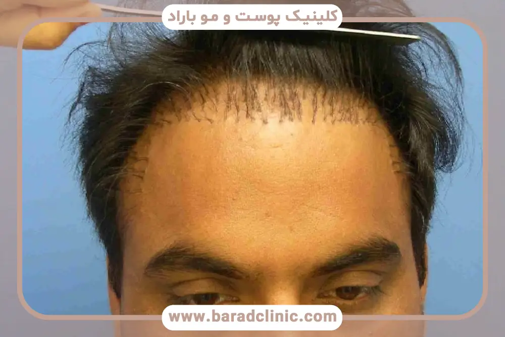 کاشت مو عروسکی