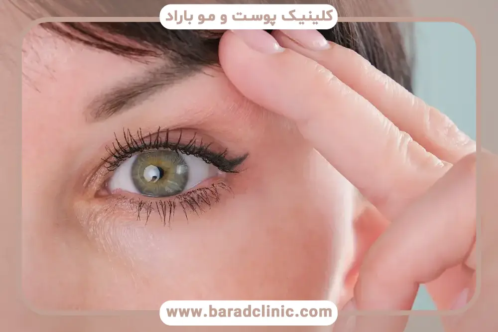 انحراف چشم بعد از بلفاروپلاستی