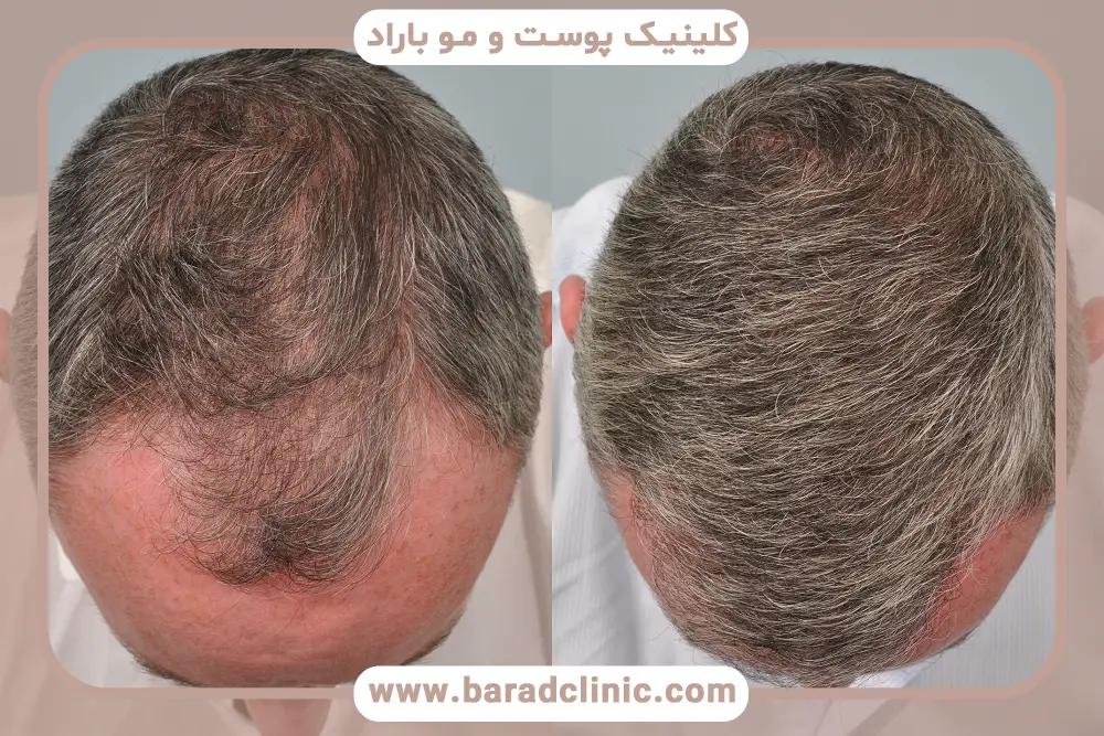 مراقبت های بعد از کاشت مو