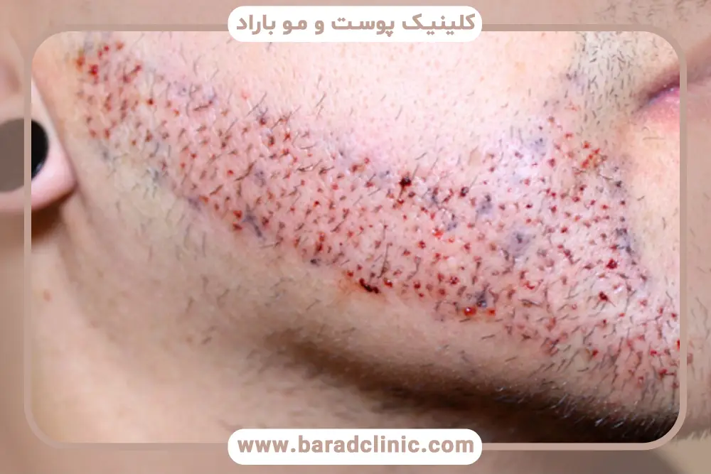 رفع جای زخم کاشت ریش