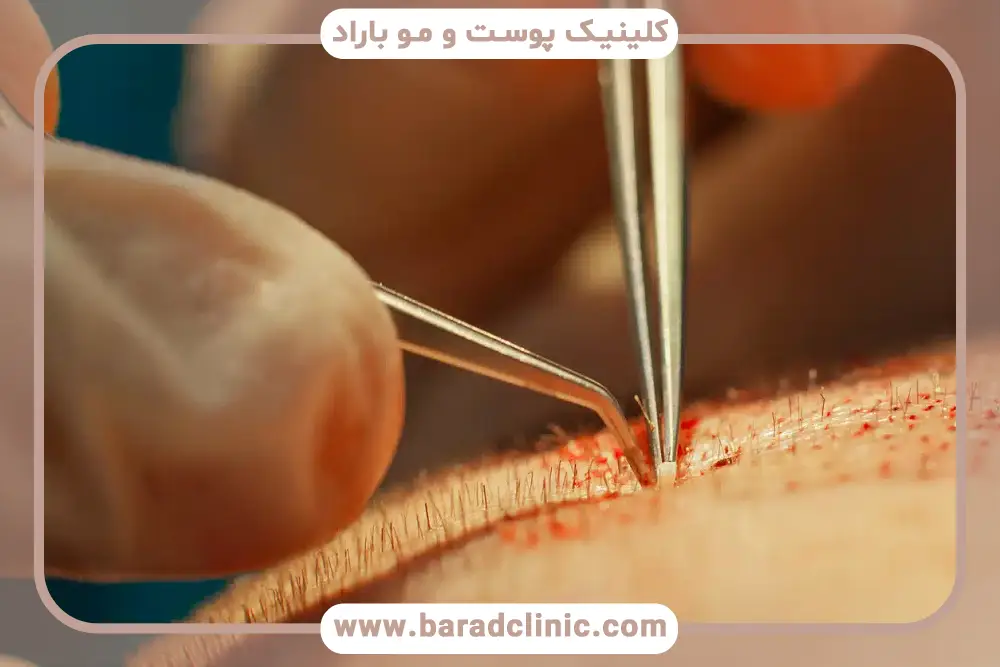 ماندگاری کاشت مو