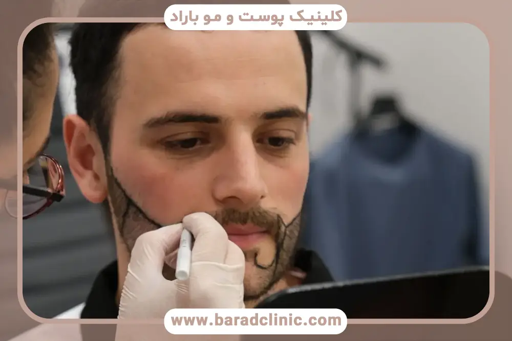 کاندیدای کاشت ریش