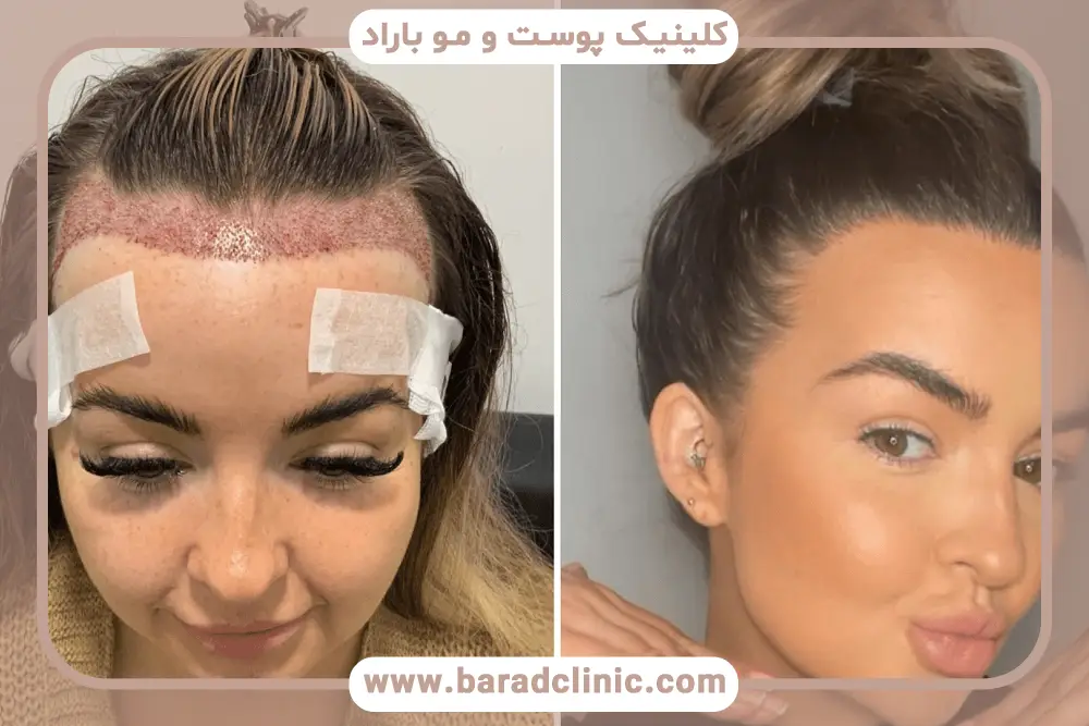 شرایط کاشت مو در زنان