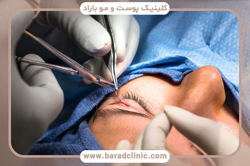عوارض جراحی بلفاروپلاستی