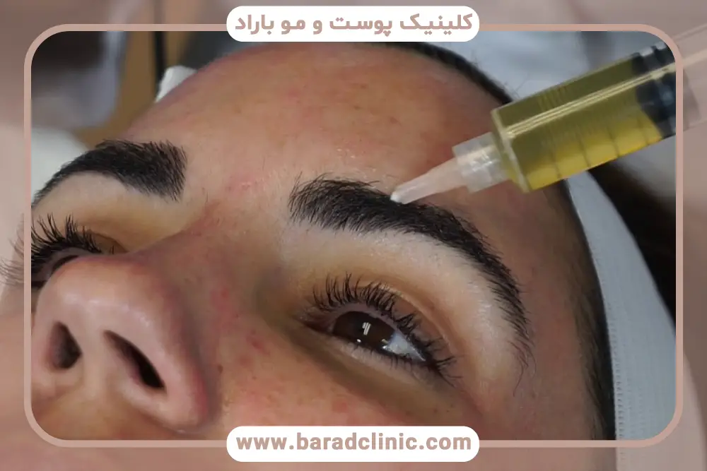 پی ار پی بعد از کاشت ابرو