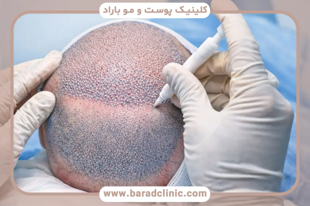 کاشت مو قسطی با اسنپ پی