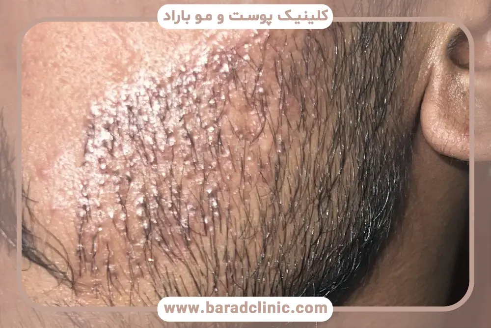 جوش بعد از کاشت ریش