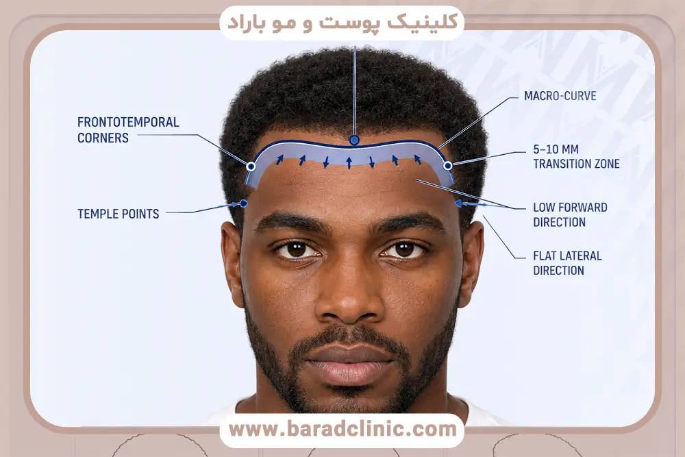 فاصله استاندارد خط رویش مو تا ابرو