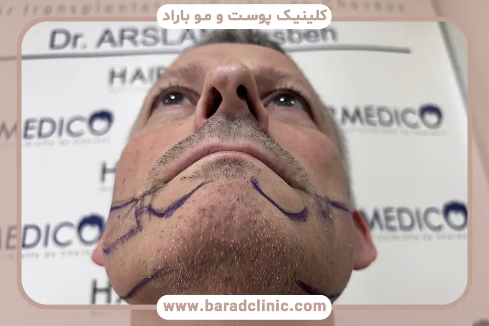 طراحی خط ریش قبل از کاشت