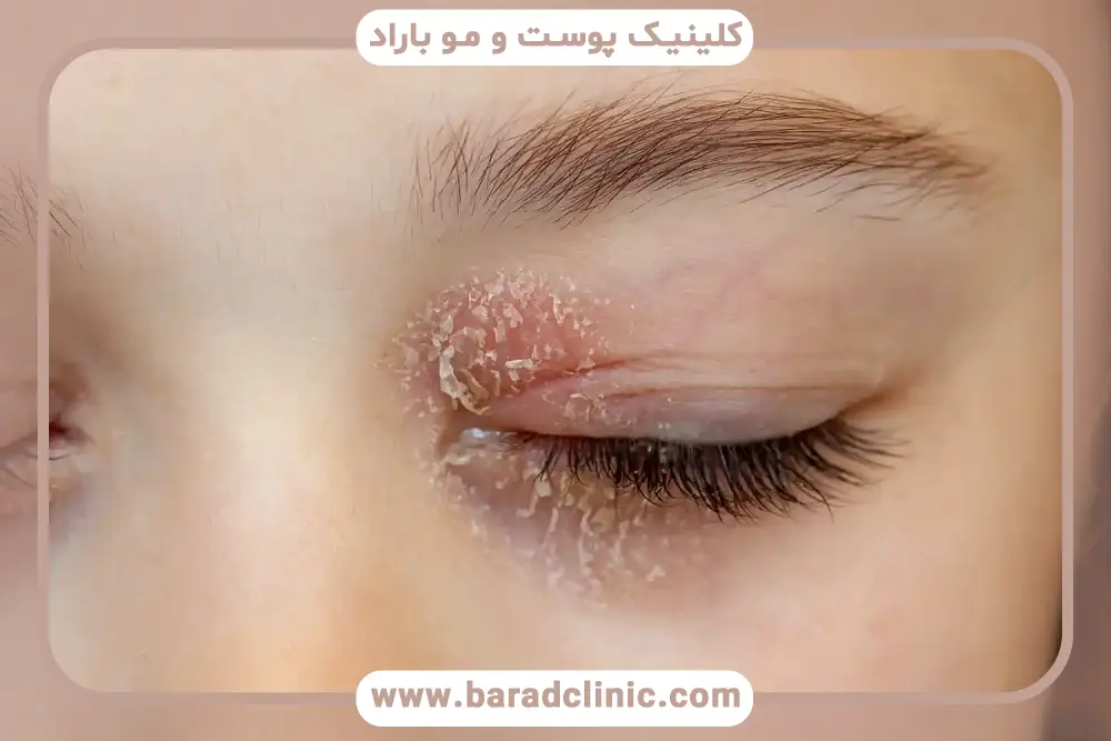 بلفاریت چشم یا التهاب پلک