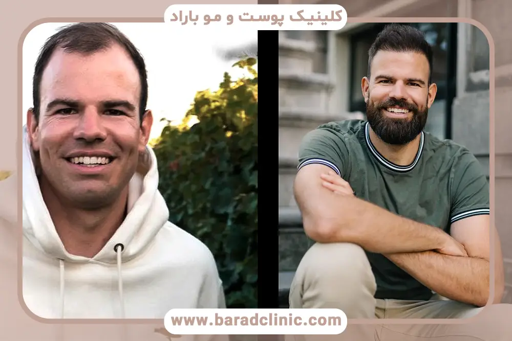 کاشت مو به روش AMT