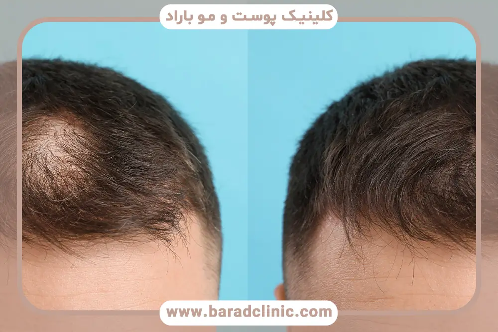 کربوکسی تراپی بعد از کاشت مو