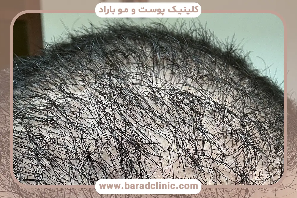 کاشت موی ناموفق