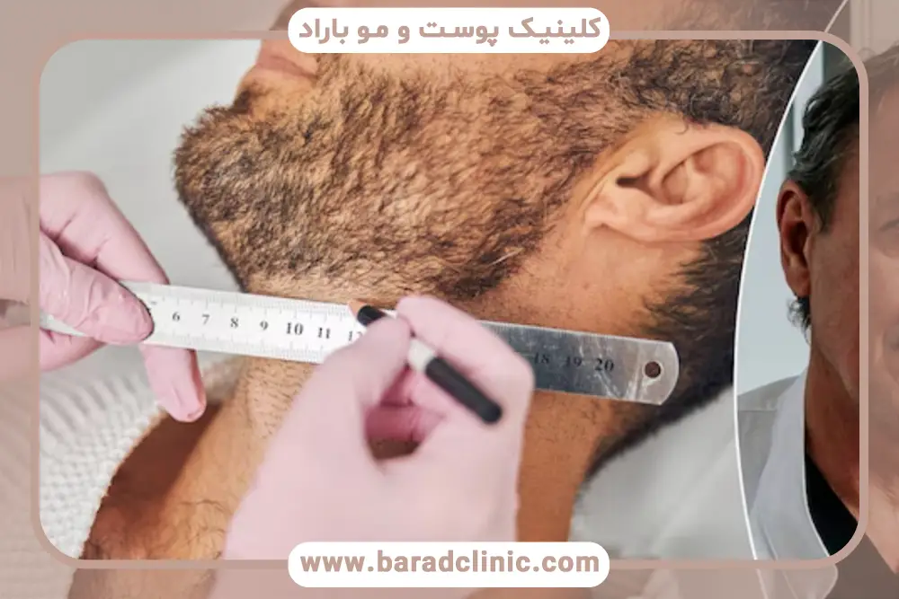 برآورد هزینه کاشت ریش رایگان