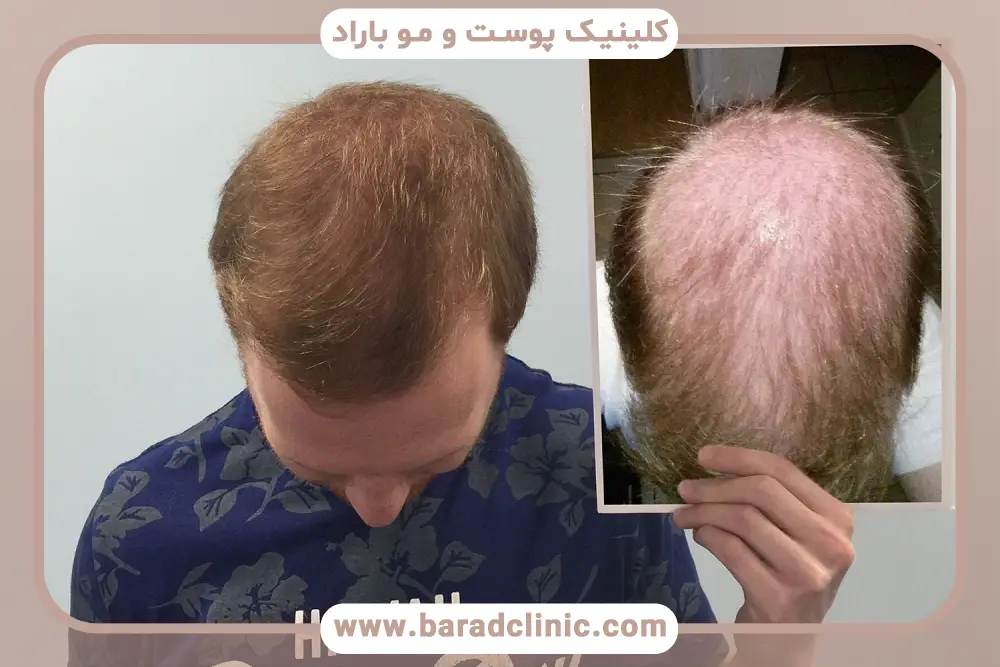 کاشت مو برای موهای نازک
